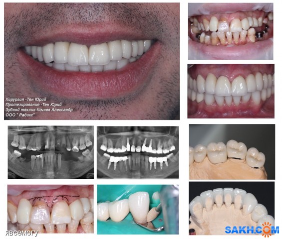 Пластика зубов фото явсемогу. :: Мои работы сделанные в Радиксе